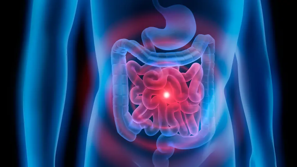 el-cancer-de-colon-es-el-mas-diagnosticado-en-espana